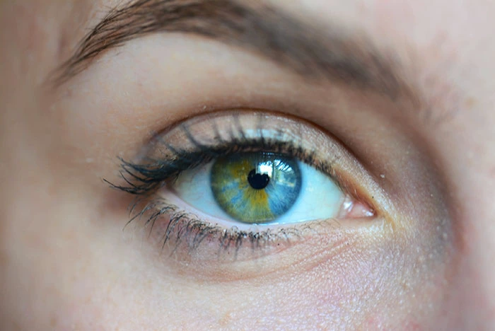 Sectoral Heterochromia